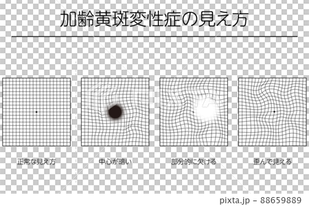 眼病、加齢黄斑変性症の見え方の図解 眼病、加齢黄斑変性症の見え方の図解 88659889