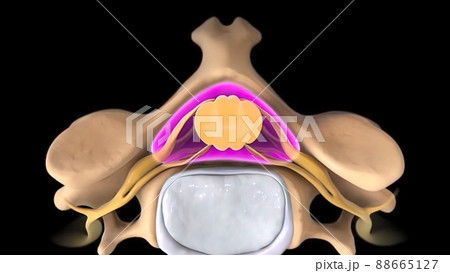 Pressure on nerves as a result of slipped disc 88665127