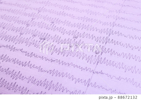 Results of electroencephalogram on paper, diagnostics of epilepsy 88672132