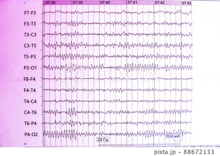Results of electroencephalogram on paper, diagnostics of epilepsy 88672133