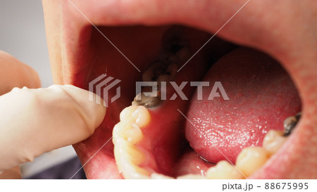 Decayed tooth root canal treatment. Tooth or teeth decay of lower molar. Restoration with a composite filling. Adult caries. bad teeth. Dental temporary restorative material. Dental concept. close up. Decayed tooth root canal treatment. Tooth or teeth decay of lower molar. Restoration with a composite filling. Adult caries. bad teeth. Dental temporary restorative material. Dental concept. close up. 88675995