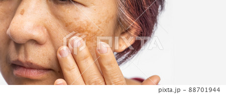 Menopausal women worry about melasma on face. 88701944