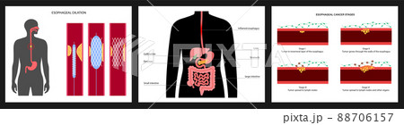 Esophageal carcinoma concept 88706157