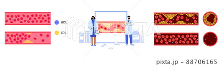 Cholesterol blood artery 88706165