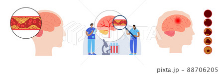 Brain stroke ishemic 88706205