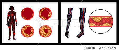 Peripheral artery disease 88706649