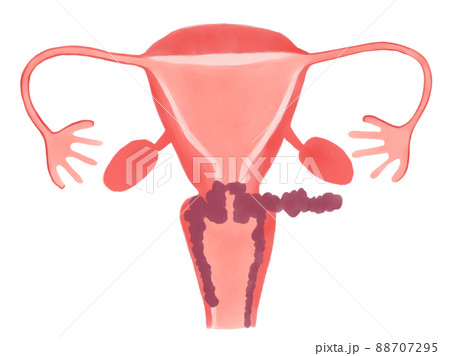 子宮頸がんの病期と進行度(ⅢB期) 子宮頸がんの病期と進行度(ⅢB期) 88707295