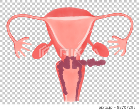 子宮頸がんの病期と進行度(ⅢB期) 子宮頸がんの病期と進行度(ⅢB期) 88707295