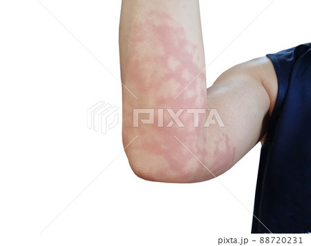 red rash on arm allergic reaction white background red rash on arm allergic reaction white background 88720231