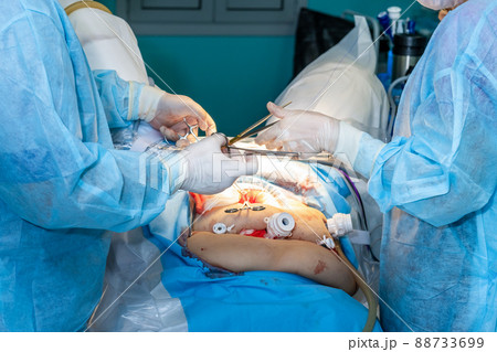 The medical team performs an operation on the abdominal cavity. The medical team performs an operation on the abdominal cavity. 88733699