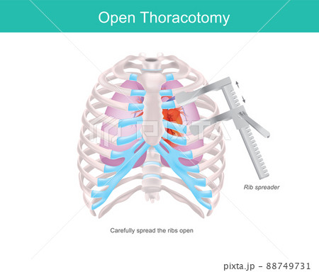 Open Thoracotomy. A procedure to gain access into the pleural space of the human chest by medical tool called Rib spreader. . Open Thoracotomy. A procedure to gain access into the pleural space of the human chest by medical tool called Rib spreader. . 88749731