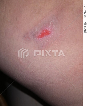 一番痛い時(閲覧注意) 一番痛い時(閲覧注意) 88767343