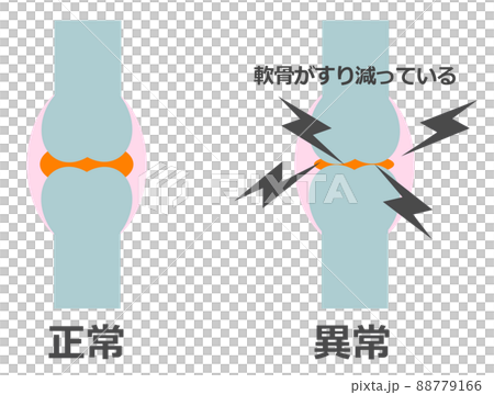 Illustration of normal bones and abnormal and painful joints Illustration of normal bones and abnormal and painful joints 88779166
