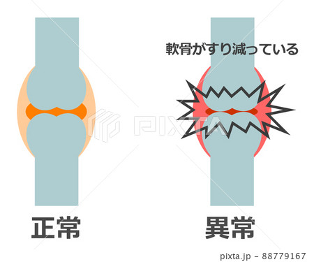正常な骨と異常で痛みがある関節のイラスト 88779167