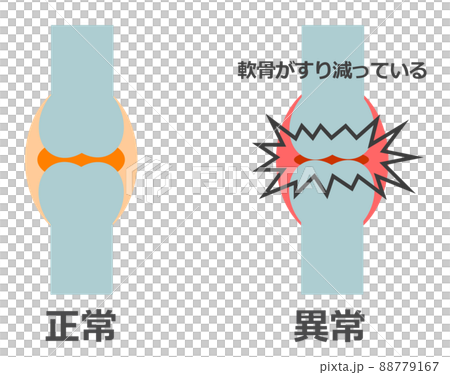 正常な骨と異常で痛みがある関節のイラスト 88779167