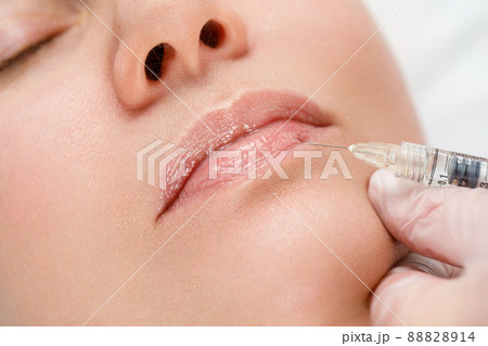 Lip shape correction procedure in a cosmetology salon. The specialist makes an injection on the lips of the patient. Lip augmentation. Lip shape correction procedure in a cosmetology salon. The specialist makes an injection on the lips of the patient. Lip augmentation. 88828914