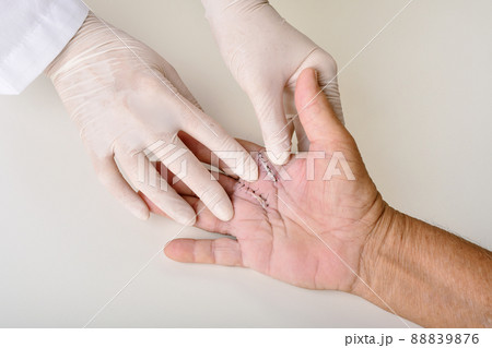 Hand surgery treatment, Trigger finger stiffness painful, Doctor treat patient's hand Hand surgery treatment, Trigger finger stiffness painful, Doctor treat patient's hand 88839876