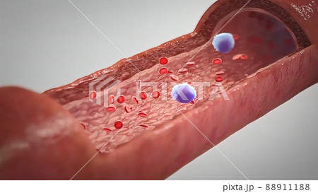 Clogged Artery with platelets and cholesterol plaque, concept for health risk for obesity 88911188
