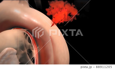 It may affect the left ventricle, aorta, aortic valve, or mitral valve. 88911205