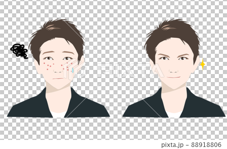 Before and After Men's Skin Care for Men Suffering from Acne __ 88918806