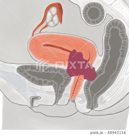 子宮頸がんの病期と進行度（ⅣB期） 88943158