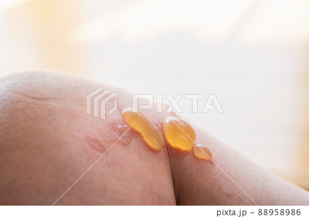 火傷して出来た水ぶくれ 88958986