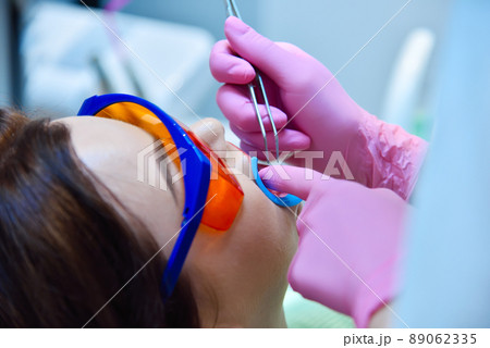 Woman patient with protective glasses and retractor for teeth whitening procedure 89062335