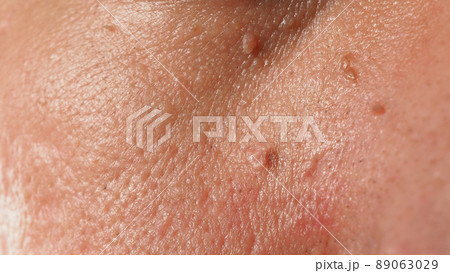 Wart skin removal. Macro shot of warts near eye on face. Papilloma on skin around eye nose and neck. Birthmark Papilla or mole on skin. small hard. benign growth on the skin caused by virus. Skincare 89063029