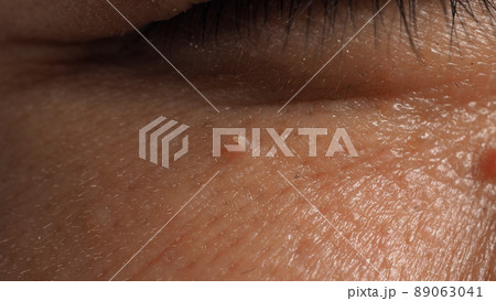 Wart skin removal. Macro shot of warts near eye on face. Papilloma on skin around eye nose and neck. Birthmark Papilla or mole on skin. small hard. benign growth on the skin caused by virus. Skincare Wart skin removal. Macro shot of warts near eye on face. Papilloma on skin around eye nose and neck. Birthmark Papilla or mole on skin. small hard. benign growth on the skin caused by virus. Skincare 89063041