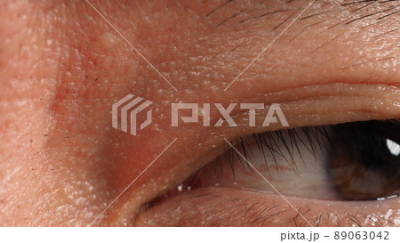 Wart skin removal. Macro shot of warts near eye on face. Papilloma on skin around eye nose and neck. Birthmark Papilla or mole on skin. small hard. benign growth on the skin caused by virus. Skincare 89063042