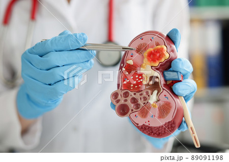 Urologist pointing pen kidney structure on anatomical model 89091198