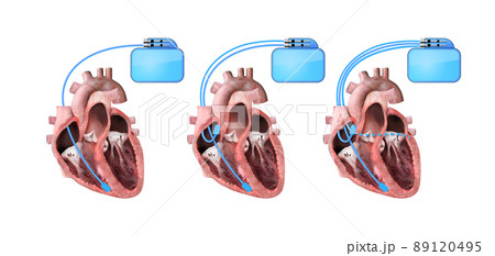 heart and cardiac pacemaker on white background 3d render, heart anatomy, section, right and left ventricle, atria, valves 89120495