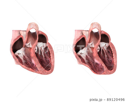 healthy heart versus aneurysm,heart anatomy, Left ventricular aneurysm, wall bulge, transmural damage, develops, dislocation, aneurysm formation, rupture, thrombus embolism 3d render 89120496
