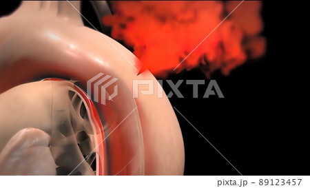 It may affect the left ventricle, aorta, aortic valve, or mitral valve. It may affect the left ventricle, aorta, aortic valve, or mitral valve. 89123457
