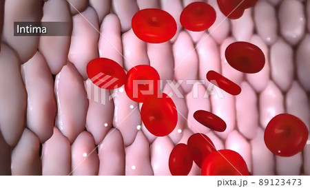 Aortic aneurysm and aortic dissection 89123473
