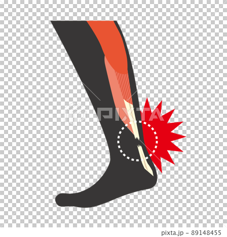 Achilles tendon rupture 89148455