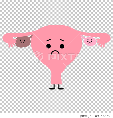 Ovarian cyst, worried uterus Ovarian cyst, worried uterus 89148469