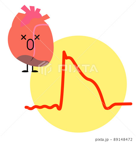 心筋梗塞で心筋が壊死してしまった心臓と心電図の波形のイラスト素材