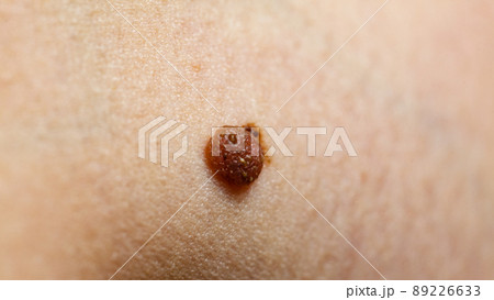 Closeup brown mole on skin. 89226633