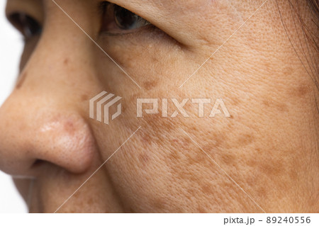 Menopausal women worry about melasma on face. 89240556