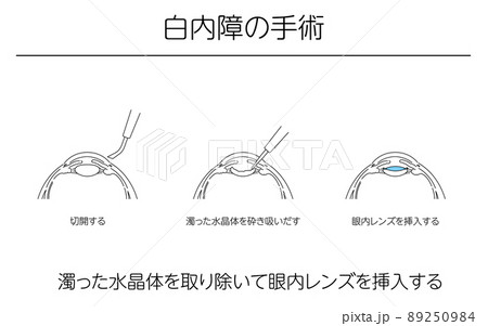 図解、緑内障の手術、メディカルイラスト 89250984