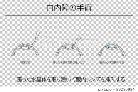 Illustrations, glaucoma surgery, medical illustrations 89250984