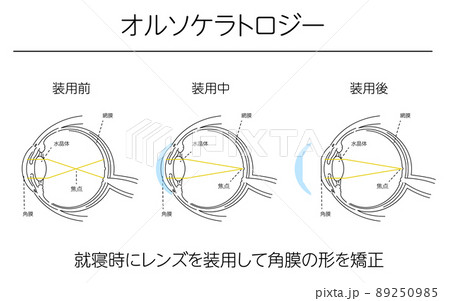 図解、オルソケラトロジーによる視力矯正、メディカルイラスト 図解、オルソケラトロジーによる視力矯正、メディカルイラスト 89250985