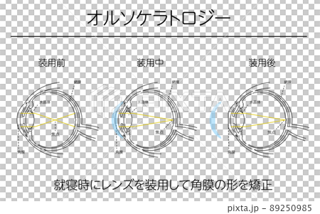 Illustration, vision correction by orthokeratology, medical illustration 89250985