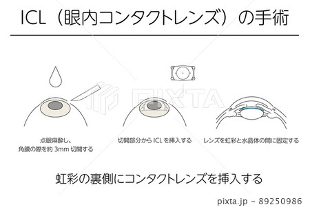 図解、ICL(眼内コンタクトレンズ)による視力矯正、メディカルイラスト 89250986