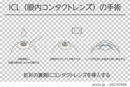 図解、ICL(眼内コンタクトレンズ)による視力矯正、メディカルイラスト 89250986