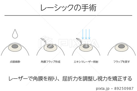 図解、レーシックによる視力矯正、メディカルイラスト 89250987