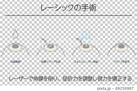 図解、レーシックによる視力矯正、メディカルイラスト 89250987