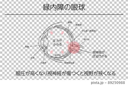 Illustrations, glaucoma eyeballs, medical illustrations Illustrations, glaucoma eyeballs, medical illustrations 89250988