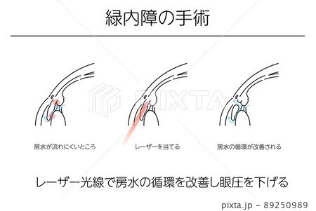 図解、緑内障の手術、メディカルイラスト 図解、緑内障の手術、メディカルイラスト 89250989